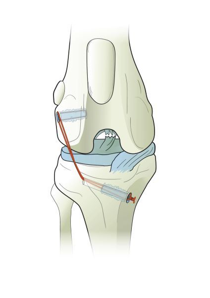  Ti-Force Full Thread Anchors použité při opravě vazů kloubů