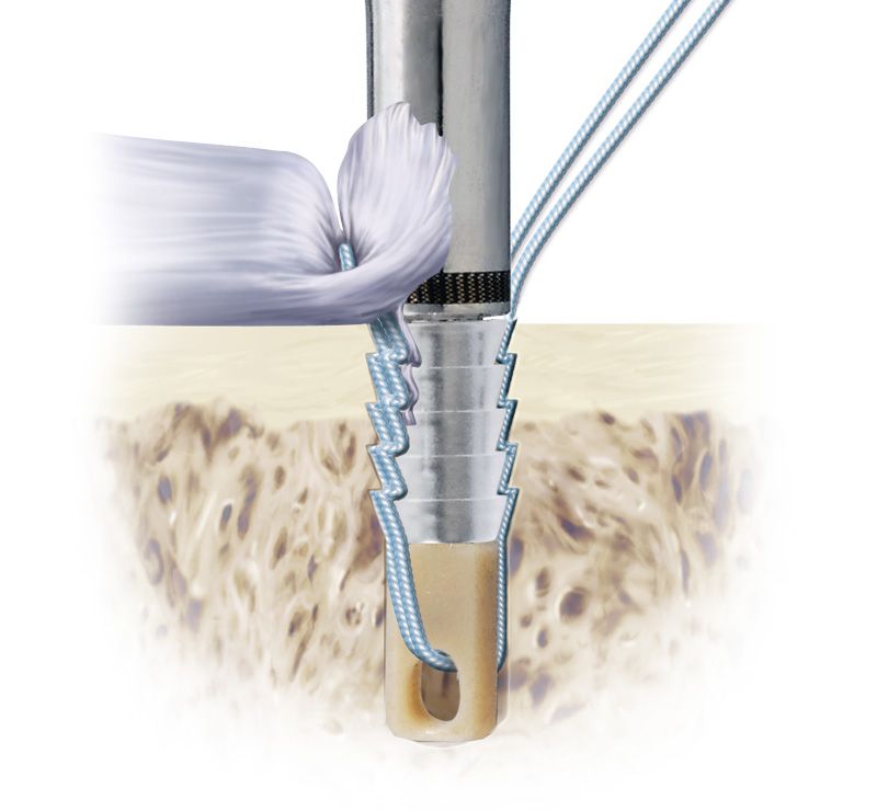  Bio-Force Soft Anchor v chirurgických scénářích